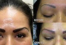 Eyebrow Transplant Chicago