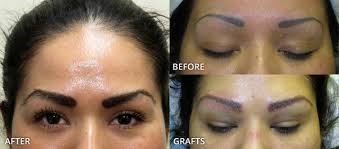 Eyebrow Transplant Chicago