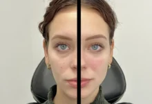 Best treatments for your skin Chicago