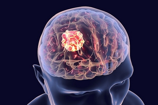 Brain Tumor Treatment Cost in India