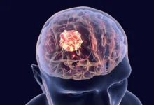 Brain Tumor Treatment Cost in India