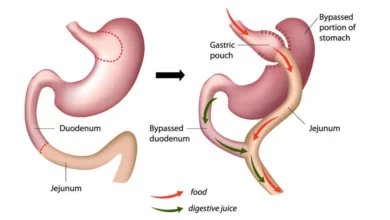 Laparoscopic Gastric Bypass Surgery in India