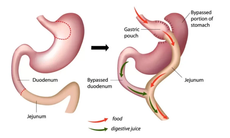 Laparoscopic Gastric Bypass Surgery in India