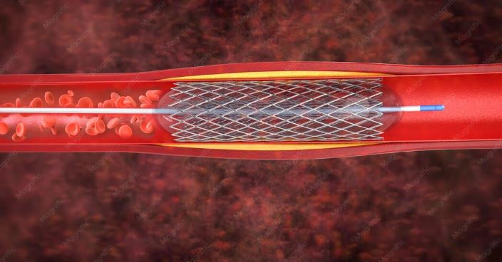 Angioplasty